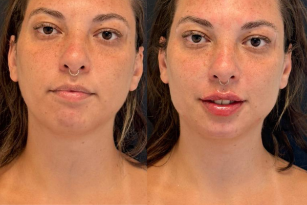 Harmonização Facial (Full Face)