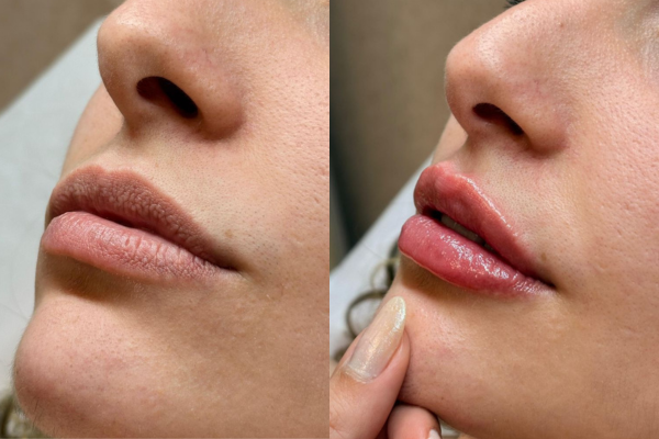 Preenchimento Labial