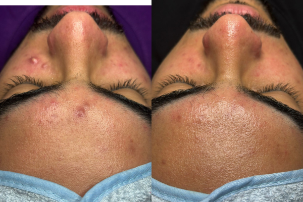 Tratamento para Acne
