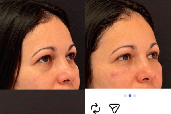 Preenchimento de Olheiras